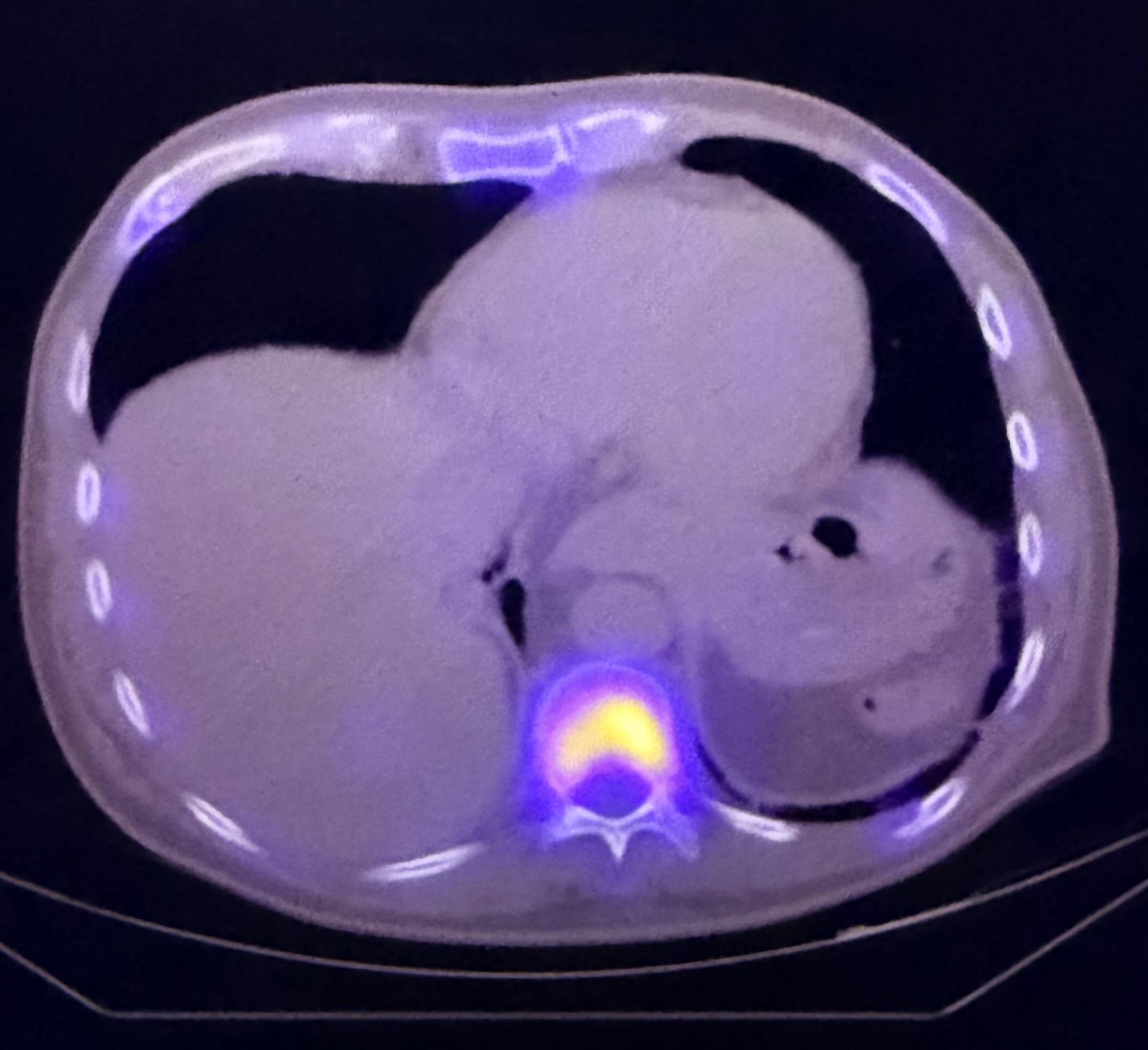 PET/CT example used to illustrate advanced head-and-neck cancer staging