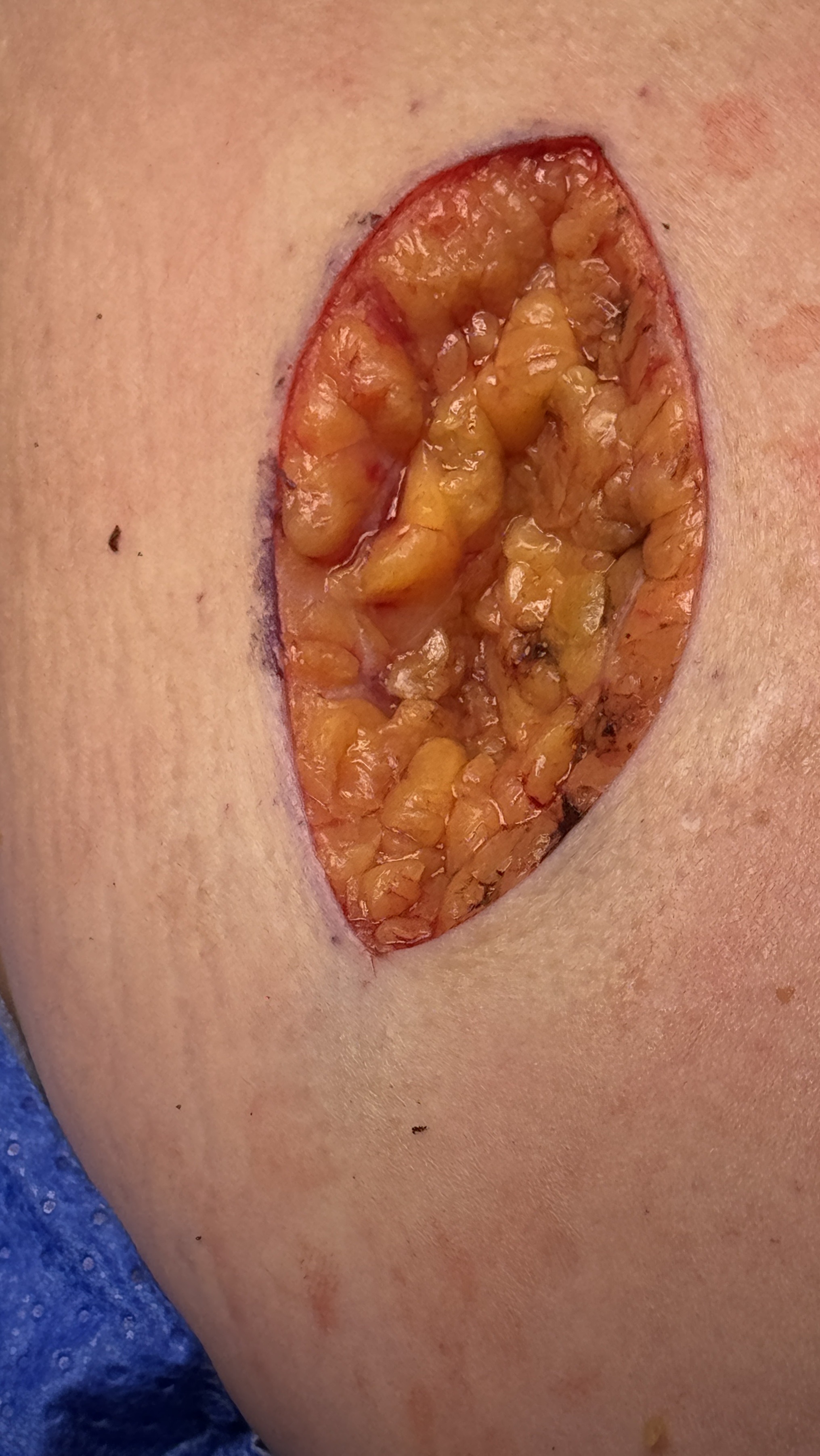 Surgical/gross lesion image used to illustrate visible cancer assessment